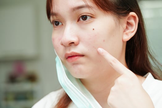 Acne pimple and scar on skin face, disorders of sebaceous glands, teenage girl skincare beauty problem. photo