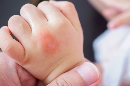 baby hand with skin rash and allergy with red spot cause by mosquito bite photo