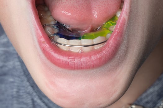 The boy wears a dental plate on his lower jaw. photo