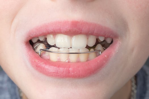The boy wears a dental plate on his lower jaw. photo