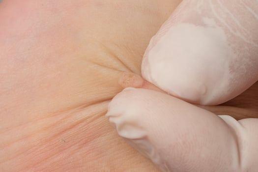 A doctor examines a wart on a child's body. photo