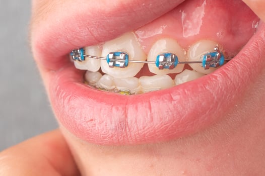 Braces with blue and yellow rubber bands close-up. photo