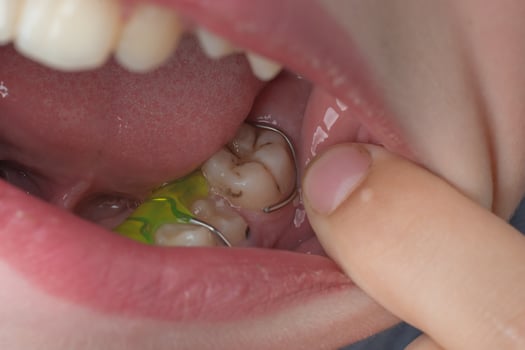 Mandibular plate, a boy wears a plate to align his teeth. photo