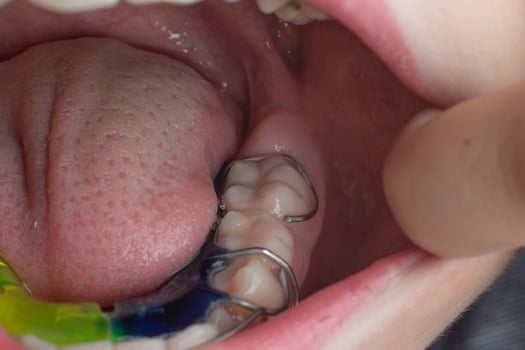 Mandibular plate, a boy wears a plate to align his teeth. photo