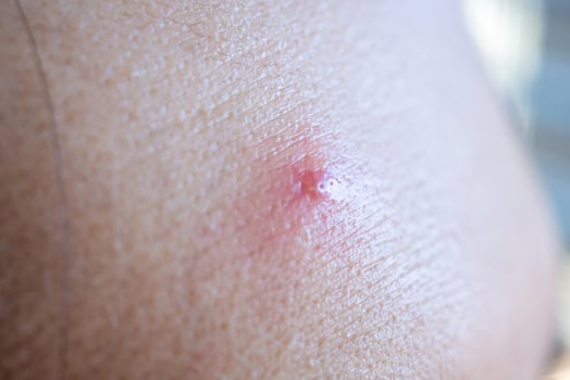 Inflammatory acne with red spot on face closeup photo