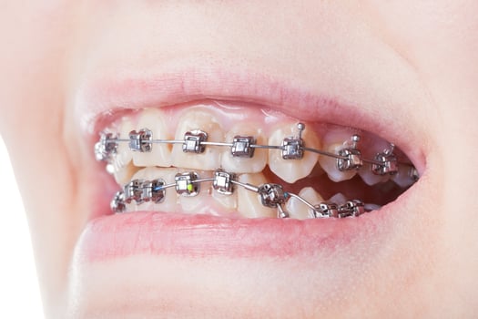 dental steel brackets on teeth close up photo