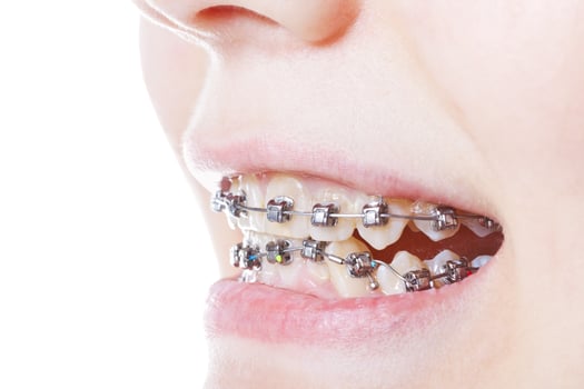 dental steel braces on teeth close up photo