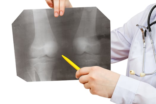 nurse points X-ray picture with human knee joint photo