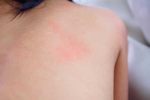little asian girl skin rash and allergy with red spot cause by mosquito bite at back photo