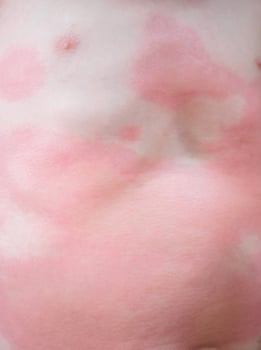 Severe eczema skin rash and allergic reaction symtom at little asian child body cause by hypersensitivity photo