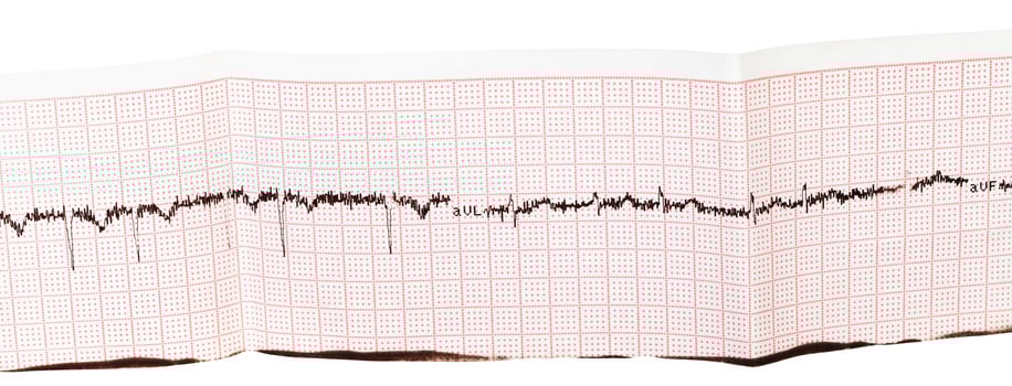 electrocardiogram ECG, EKG on paper photo
