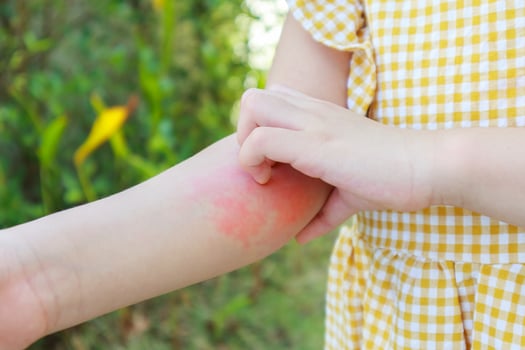 Little girl has skin rash allergy and itchy on her arm photo