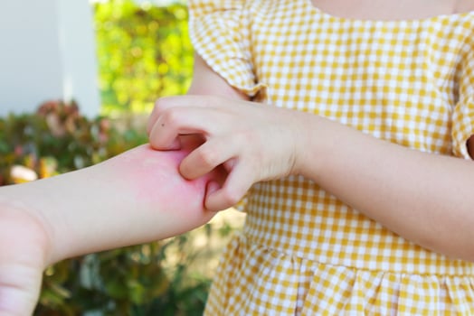 Little girl has skin rash allergy and itchy on her arm photo