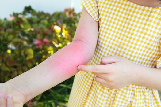 Little girl has skin rash allergy and itchy on her arm photo