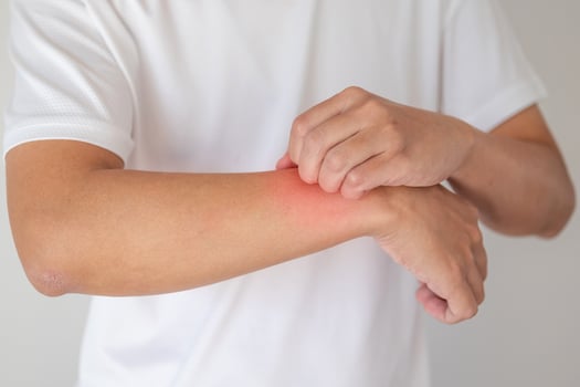 man itching and scratching on arm from itchy dry skin eczema dermatitis photo