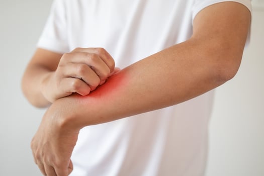 man itching and scratching on arm from itchy dry skin eczema dermatitis photo