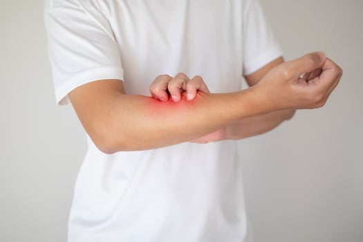 man itching and scratching on arm from itchy dry skin eczema dermatitis photo