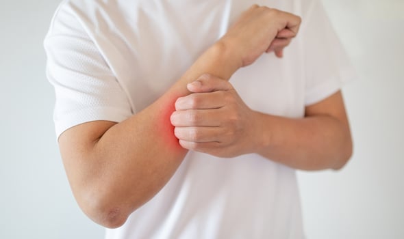 man itching and scratching on arm from itchy dry skin eczema dermatitis photo