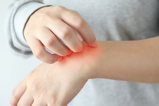 Young asian woman itching and scratching on arm from itchy dry skin eczema dermatitis photo