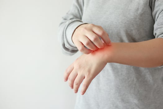 Young asian woman itching and scratching on arm from itchy dry skin eczema dermatitis photo