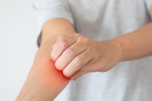 Young asian man itching and scratching on arm from itchy dry skin eczema dermatitis photo