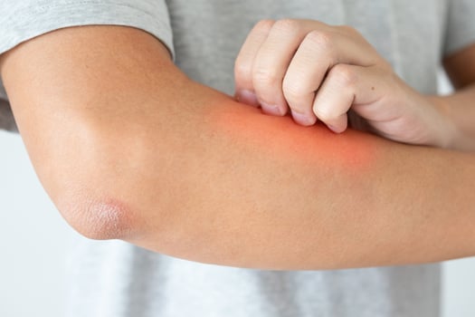 Young asian man itching and scratching on arm from itchy dry skin eczema dermatitis photo