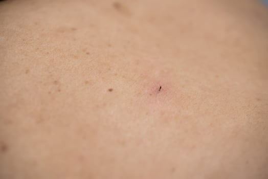 Acne on the back of the skin care woman is caused by bacteria. photo