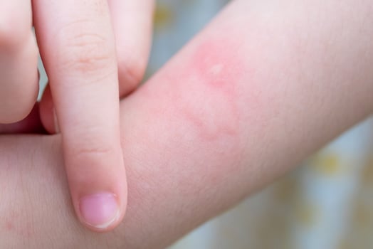 Little girl has skin rash allergy itching and scratching on her arm photo