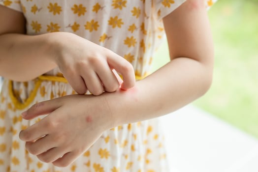 Little girl has skin rash allergy itching and scratching on her arm photo