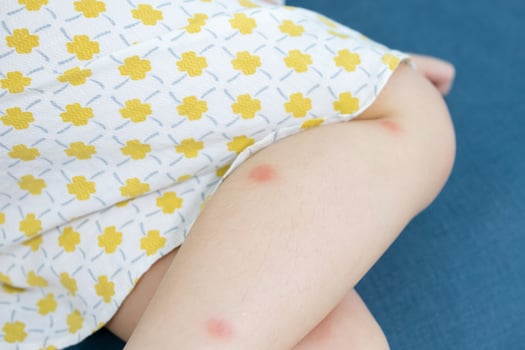 Little girl has skin rash allergy itching on her leg photo