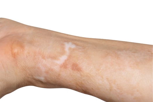 Scars on the arms. Caused by an accident, hot oil splashed onto the arm area. photo
