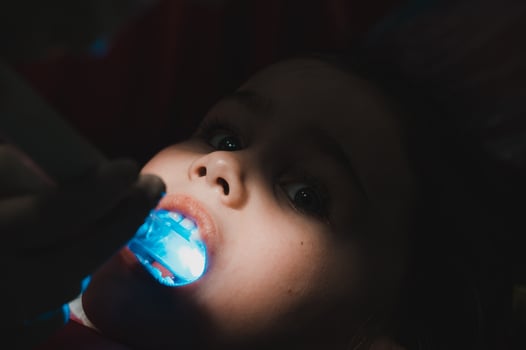 Ultraviolet light in dentistry, the dentist holds a device with ultraviolet light to quickly seal the filling in the child's tooth. photo