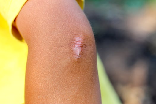 Scar on the elbow of the child. photo