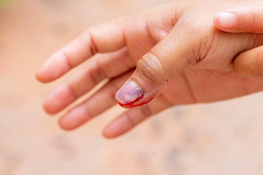 Human finger with black bruised nail with blood photo