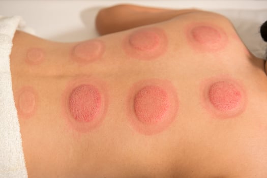 Beautiful Woman Received cupping treatment on back by  therapist, chinese medicine treatment, health and healing concept. photo