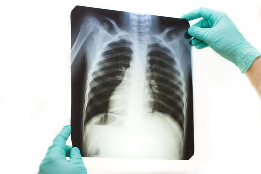 Man hand holding a lungs radiography isolated on white background. Doctor wearing mask and gloves looking at chest x-ray photo