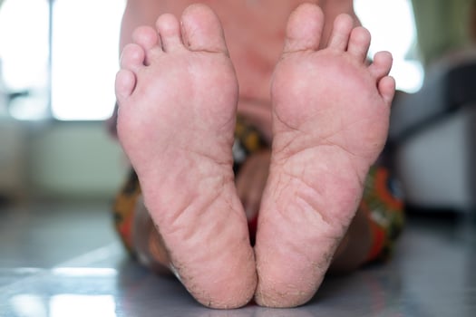 cracked feet, dry skin, close up asia senior woman cracked feet,The heels of an Asian senoir woman who shifts from walking down to the weight of the feet can be treated with weight loss exercises photo