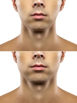 Surgery or mewing exercises. Result of a jawline reshape. photo