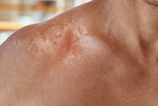 Shoulders with a hurt skin fron sun burn, closeup photo
