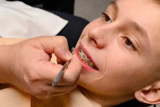 An orthodontist glues and fastens braces on the upper teeth of a schoolboy, aligning teeth with braces. photo