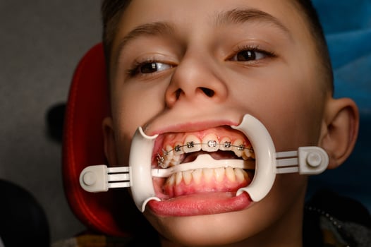 Visit to the orthodontist, installation of braces on the upper teeth, white retractor on the lips of the child. photo