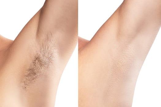 Comparison of female armpit after hair removal photo