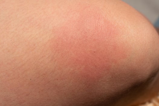 Allergy on the human body and redness from a wasp sting. photo