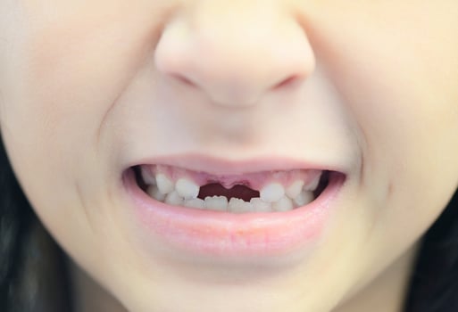 lost milk teeth - lost baby tooth , smile face of a child girl baby teeth of tooth loss , her milk tooth fell out and her growing permanent tooth in open mouth dental health problems concept photo