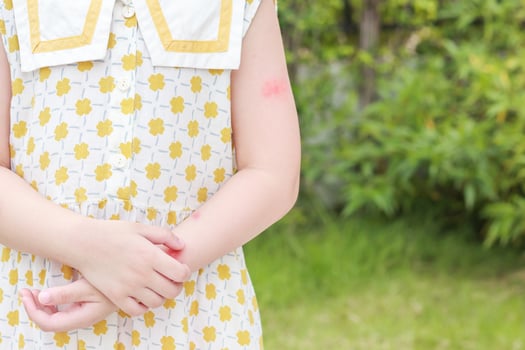 Little girl has skin rash allergy itching and scratching on her arm photo
