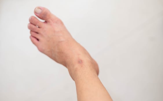 Close up of female foot with dry, cracked skin on cuticles, skin is torn and flaking off should be treat with the moisturizer for repair. photo