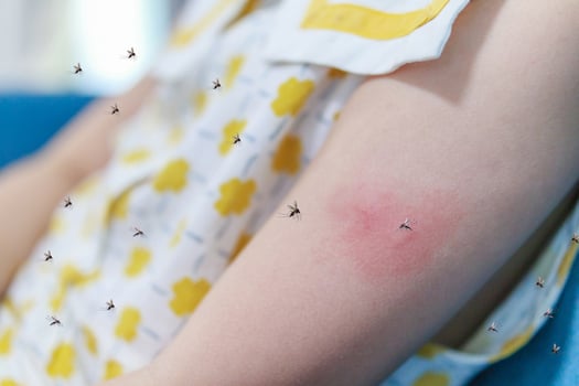 Little girl has skin rash allergy and itchy on her arm from mosquito bite photo