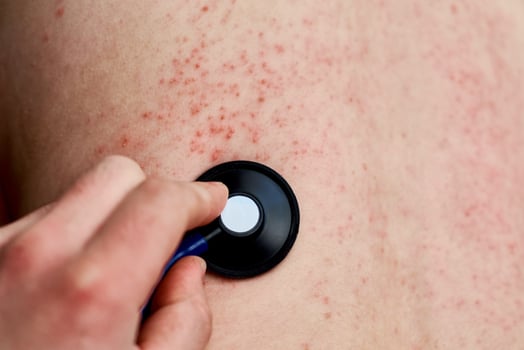 Allergic rash on skin. Woman with dermatology problem on back skin photo