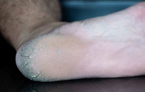 Close up cracked heel further deep cracks and dry flaky skin photo