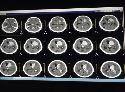 CT -Brain a human hemorrhage. photo